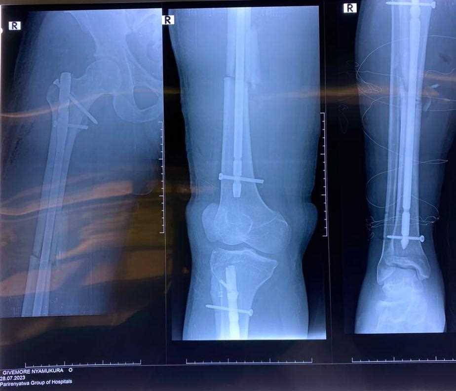 Chinese medical expertise and technology restore road crash survivor’s hope